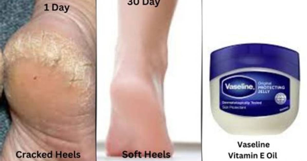 Does Vaseline Help Dry Foot?