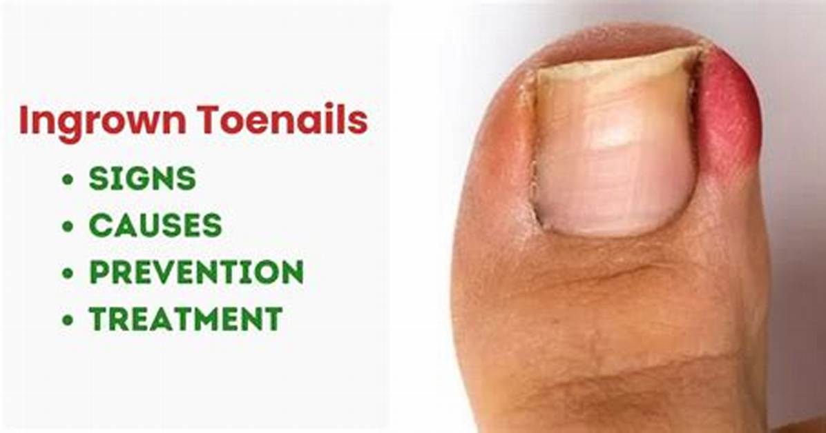 Does Vaseline Help Ingrown Toenails?