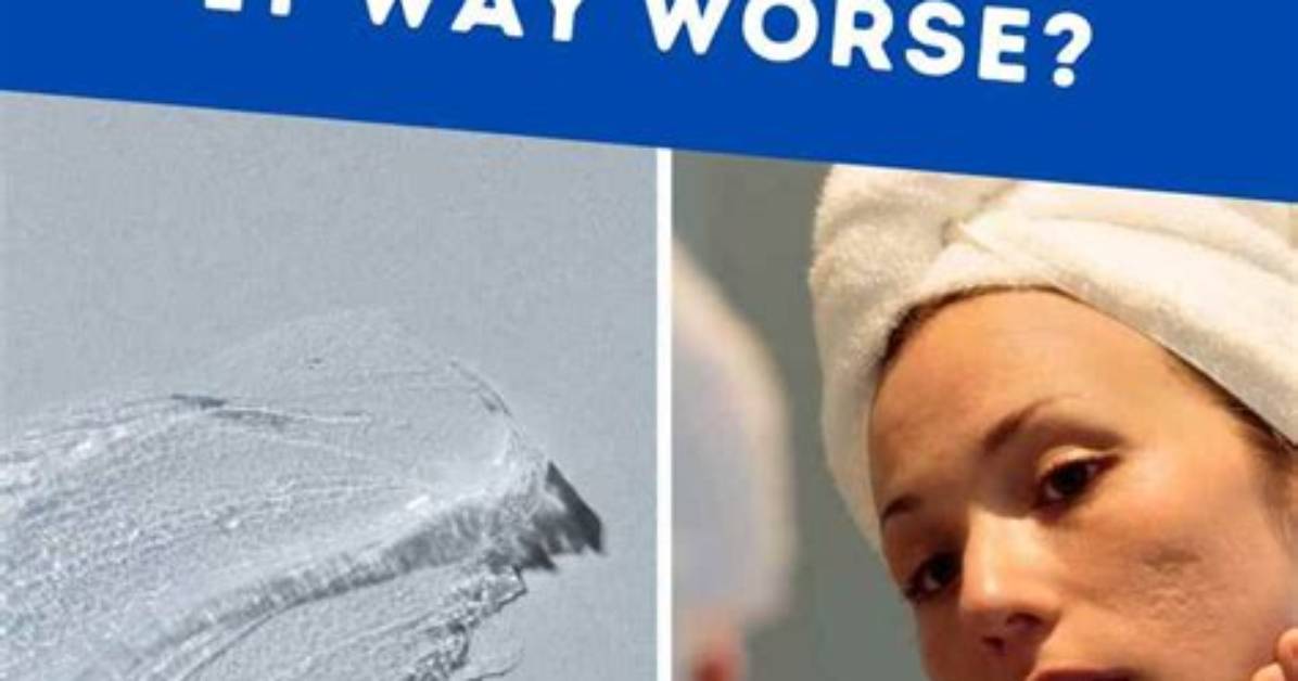 Does Vaseline Help Your Acne?