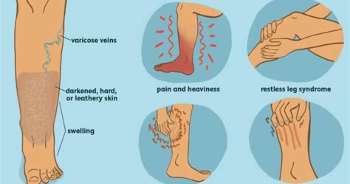 Does Venous Insufficiency Cause Itching?