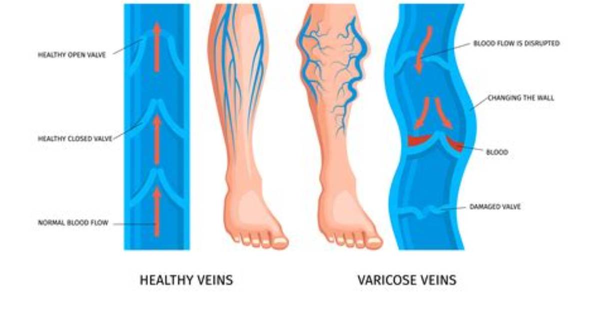 Does Venous Mean Veins