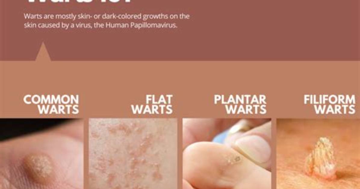 Does Veregen Cause More Warts?