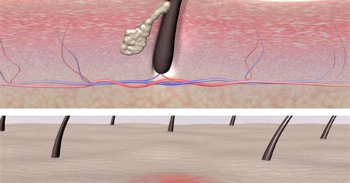 Does Waxing Cause Ingrown Hairs?