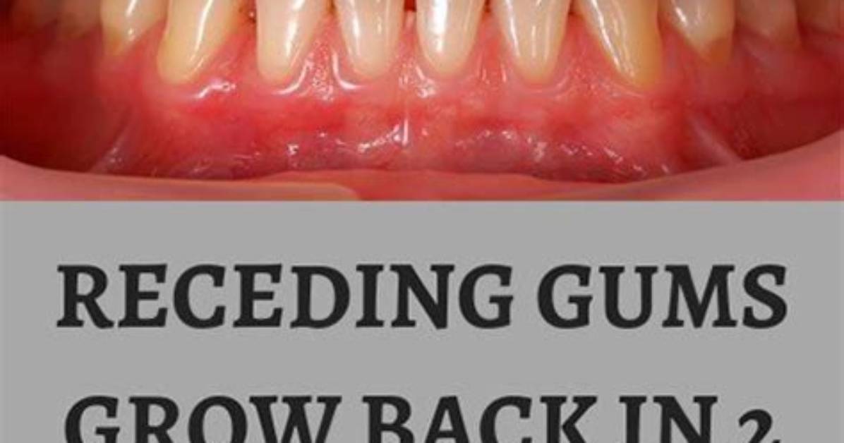 Does Your Gums Grow Back?