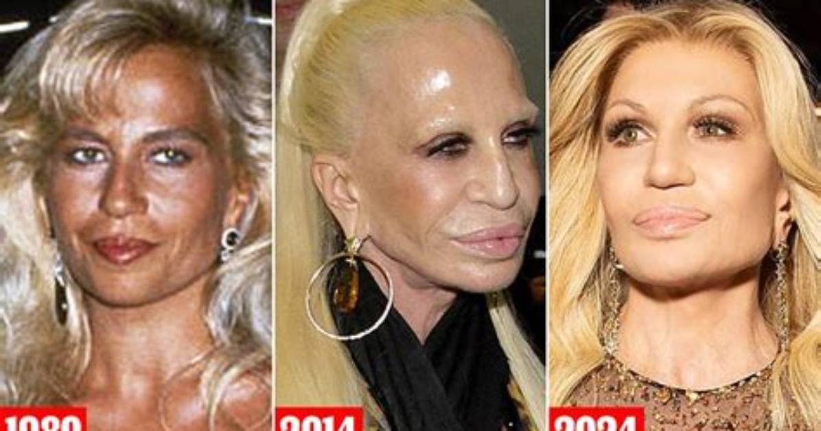 Donatella Versace's Plastic Surgery Transformations