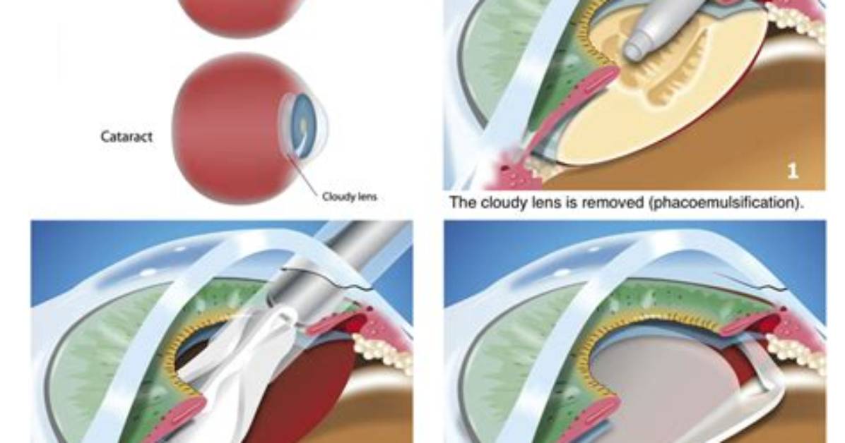 During a Cataract Procedure?