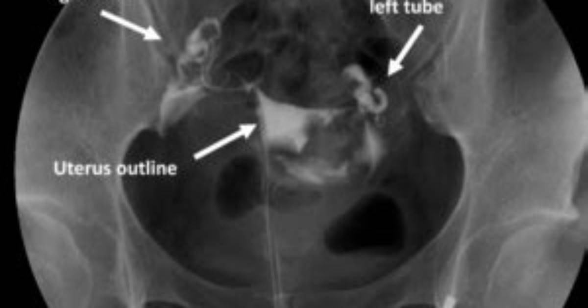 During a Normal Hysterosalpingogram What Fills First?