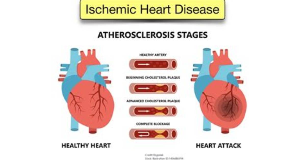During Ischemic Heart Disease?