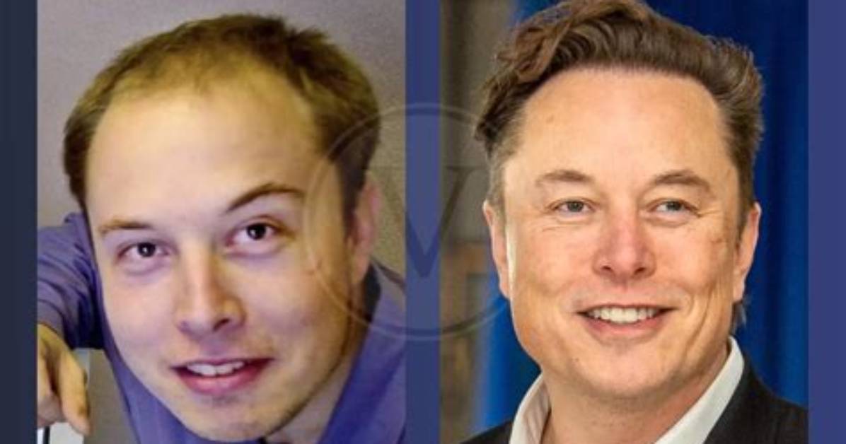 Elon Musk Before Hair Transplant | the Enigmatic Evolution