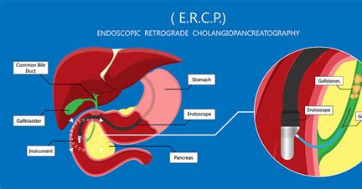 Ercp with Stent Removal Cpt Code