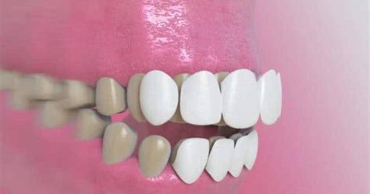 Fix Open Bite with Veneers