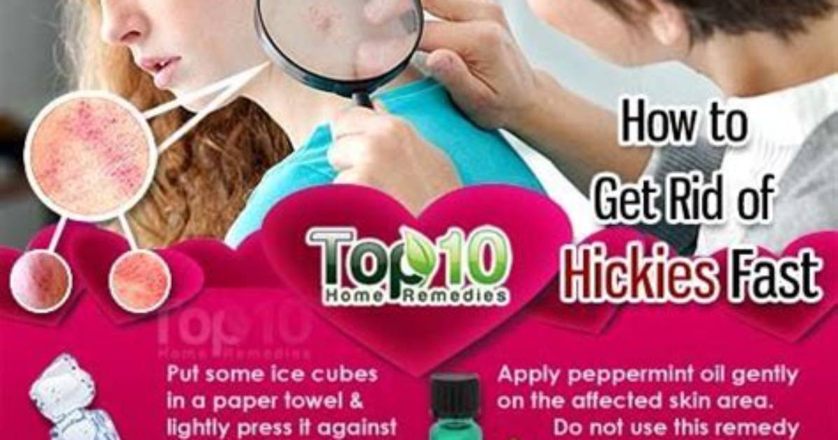 Get Rid of Hickies with These Quick Hacks