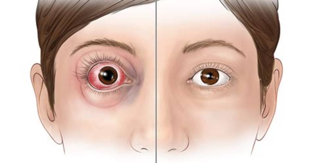 Has a Bulging Eye?