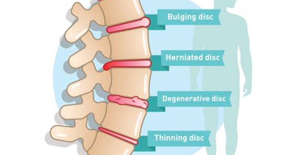 Has a Disc Problem?