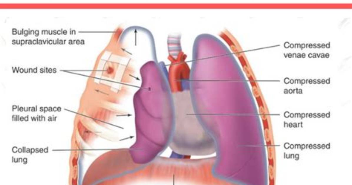 Has a Punctured Lung?