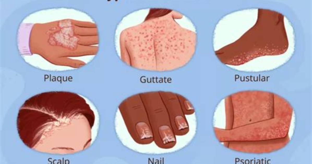Has Anyone Cured Psoriasis?