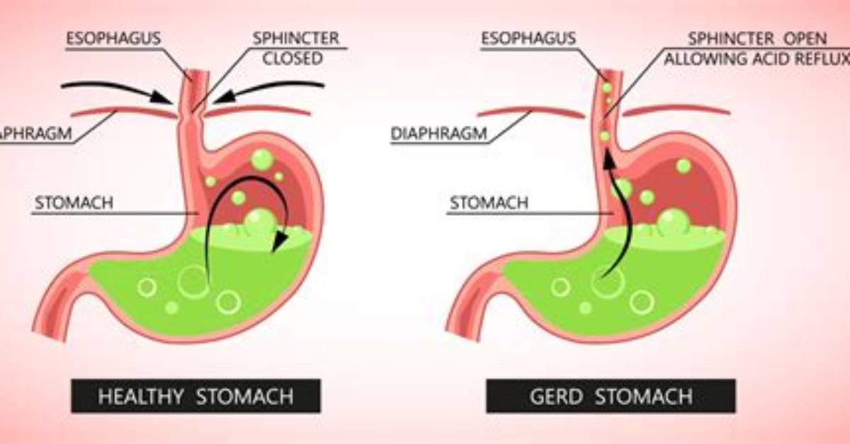 Has Anyone Cured Their Gerd?