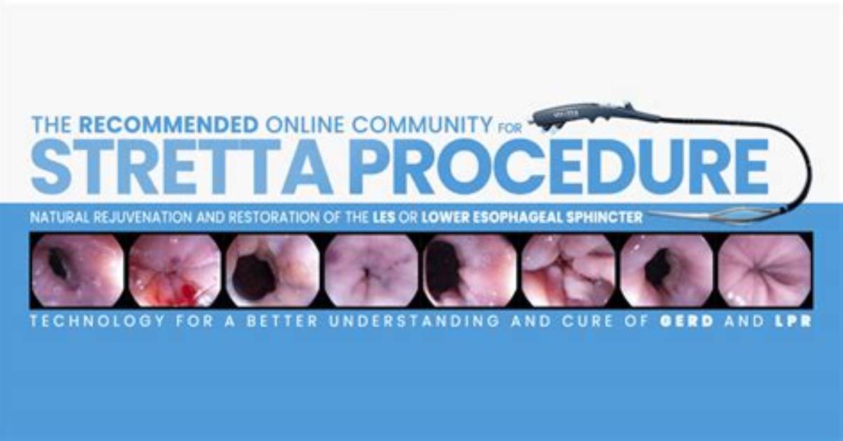 Has Anyone Had the Stretta Procedure?
