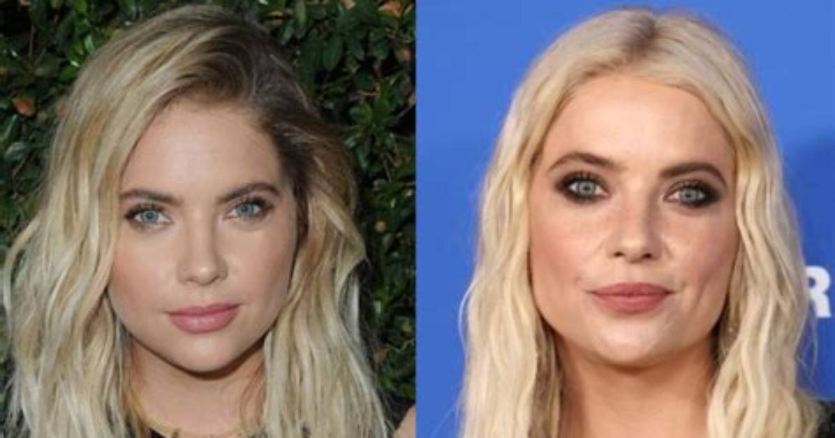 Has Ashley Benson Undergone Plastic Surgery? Find out Now