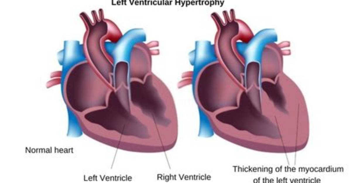 Has Left Ventricular Hypertrophy?