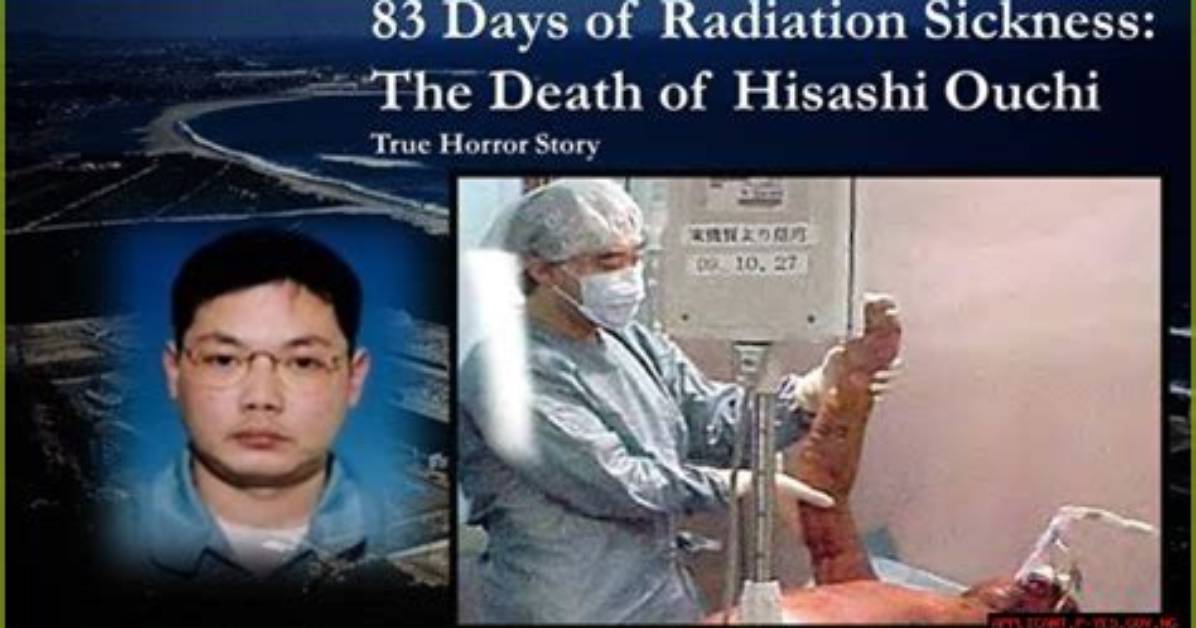 Hisashi Ouchi: the Tragic Tale of a Victim of Radiation Exposure