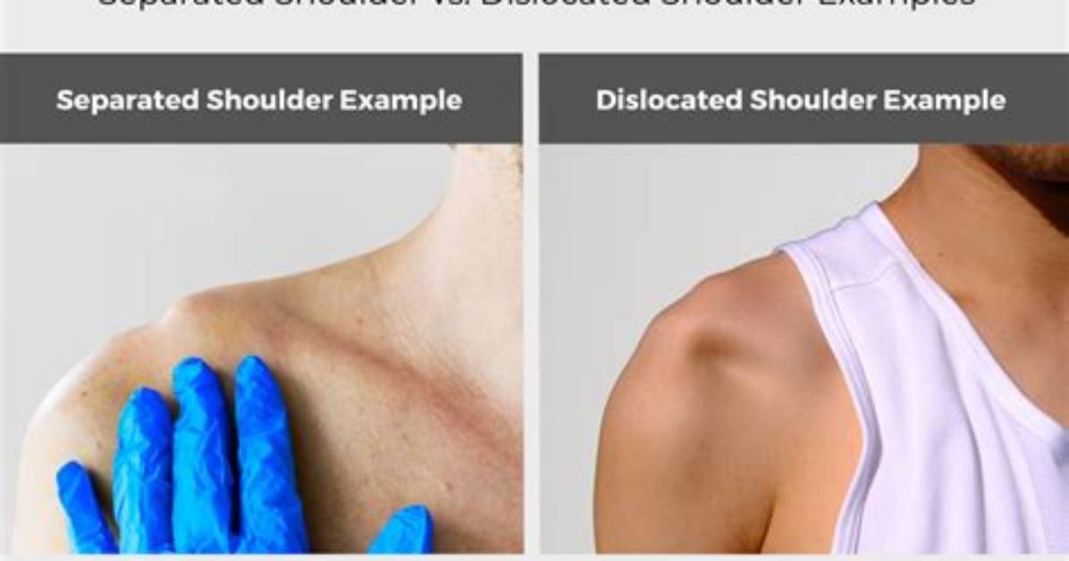 How a Dislocated Shoulder Feels?