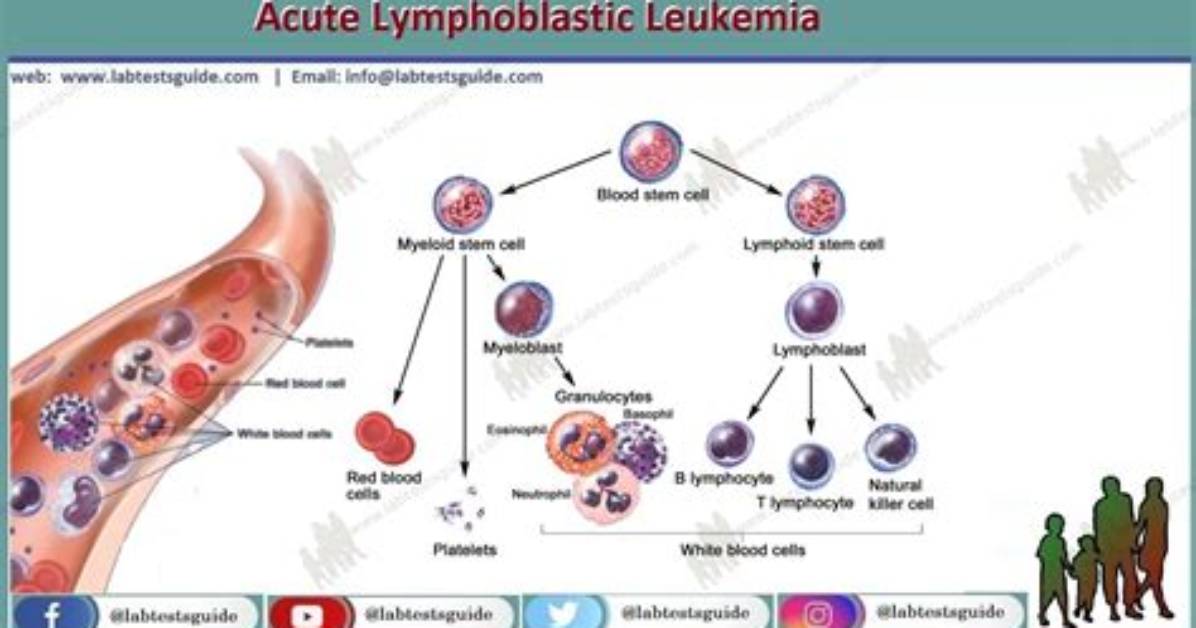 How Acute Lymphoblastic Leukemia Forms?