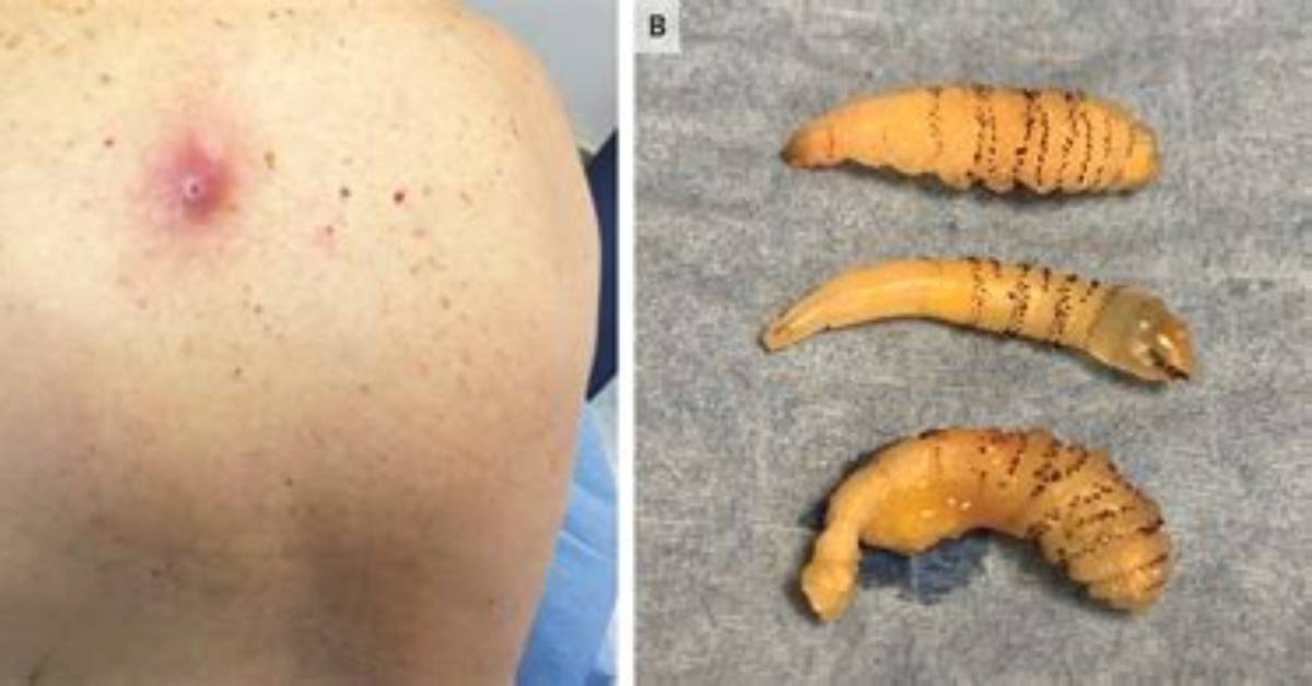 How Are Botflies Removed?