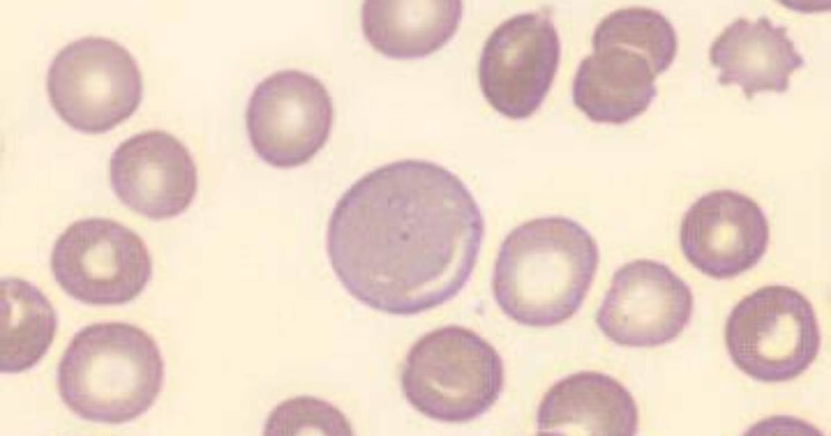 How Are Macrocytes Formed?