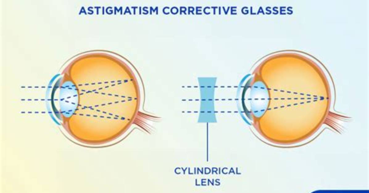 How Astigmatism Is Corrected?