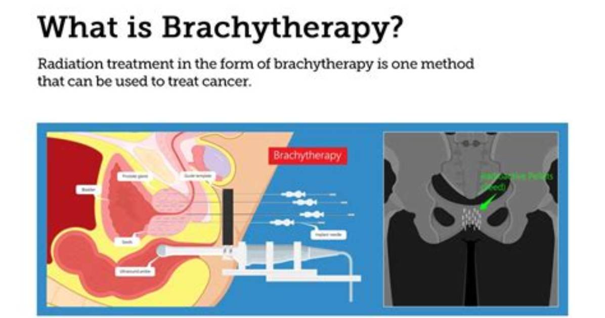 How Brachytherapy Is Performed?