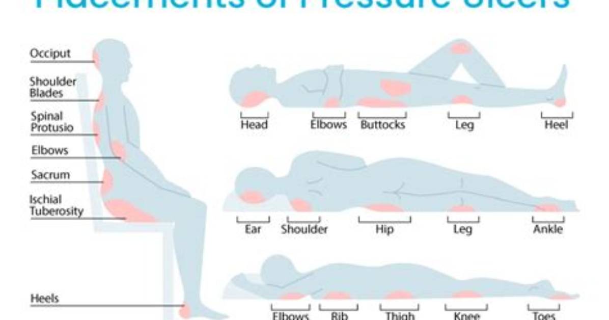 How Common Are Pressure Ulcers