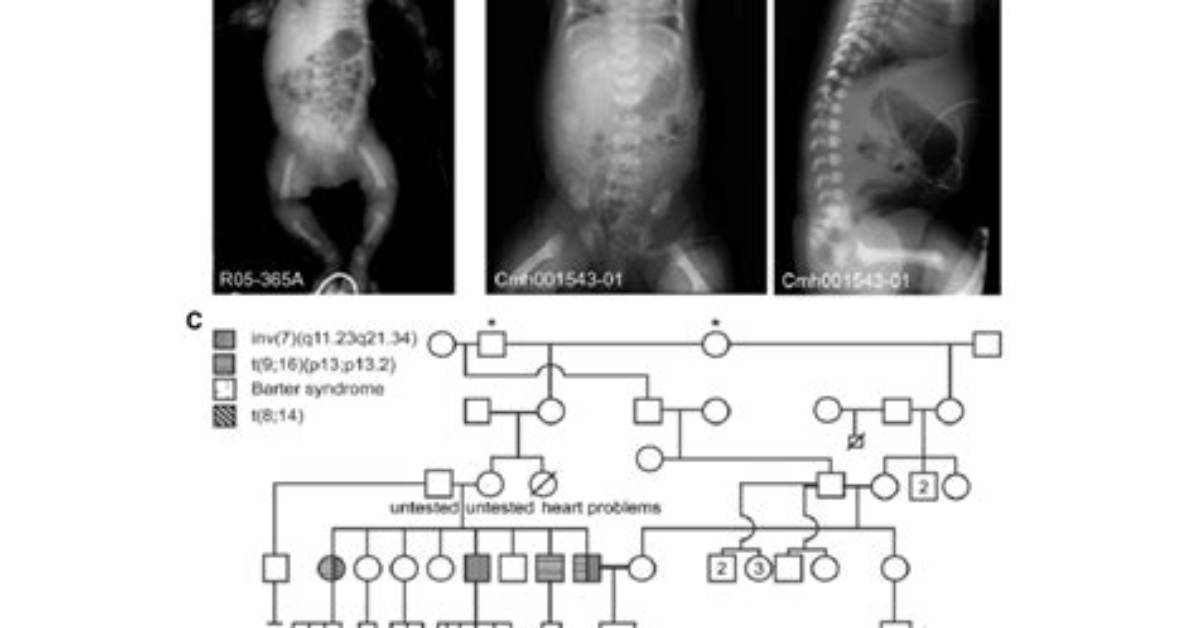 How Common Is Asphyxiating Thoracic Dystrophy?