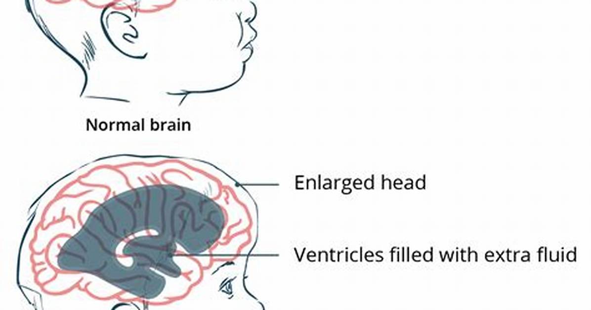 How Common Is Hydrocephalus?