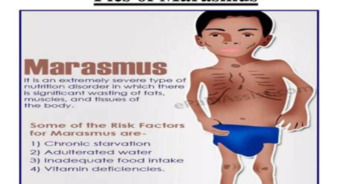 How Common Is Marasmus