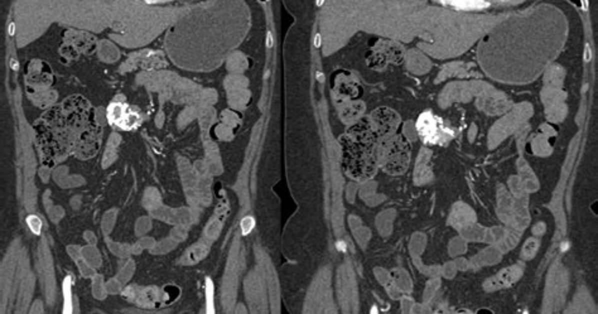 How Common Is Mesenteritis?