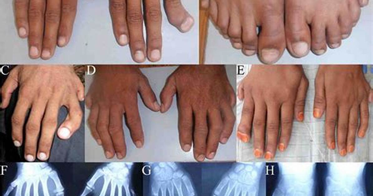 How Common Is Polydactyly in Humans?