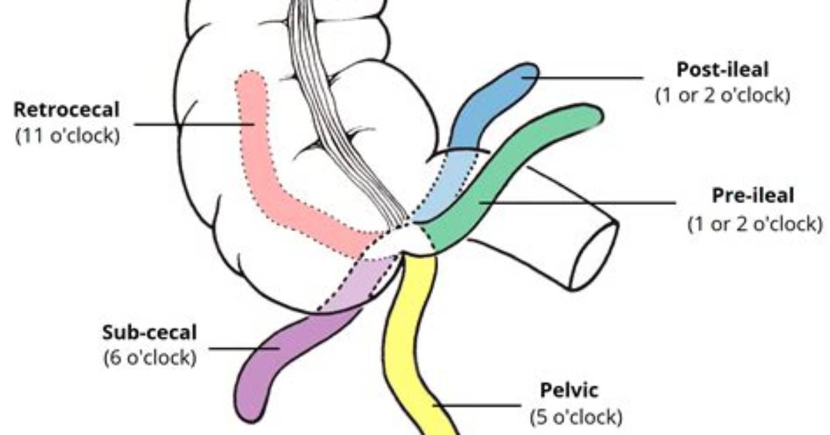 How Common Is Retrocecal Appendix?