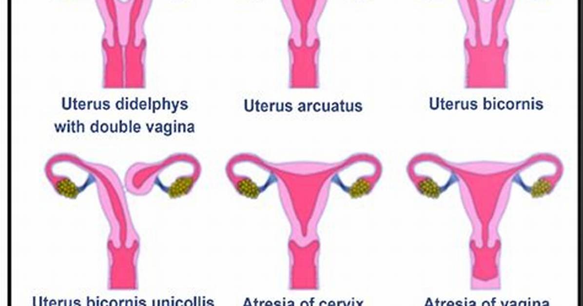 How Common Is Uterus Didelphys?