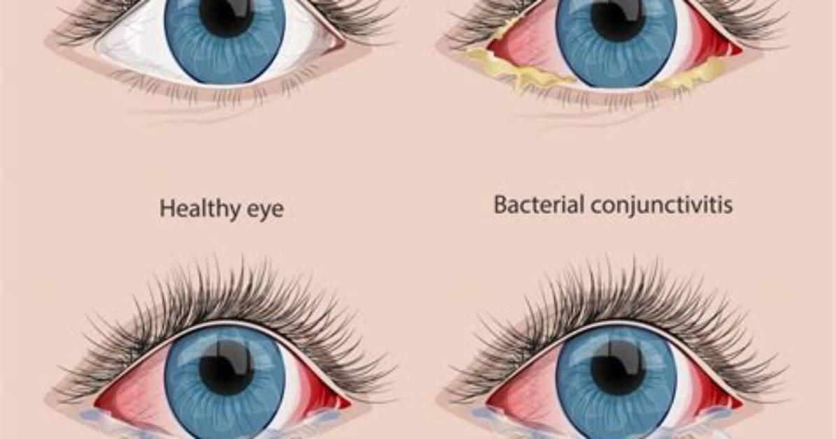 How Conjunctivitis Is Treated?