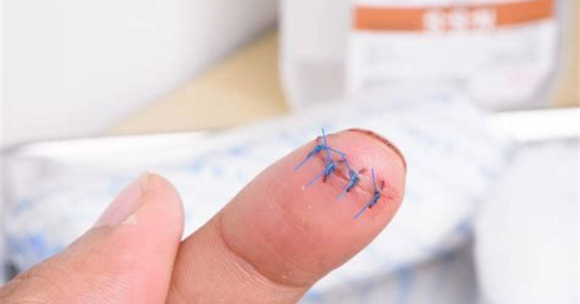 How Deep Do You Need to Cut to Leave a Scar?