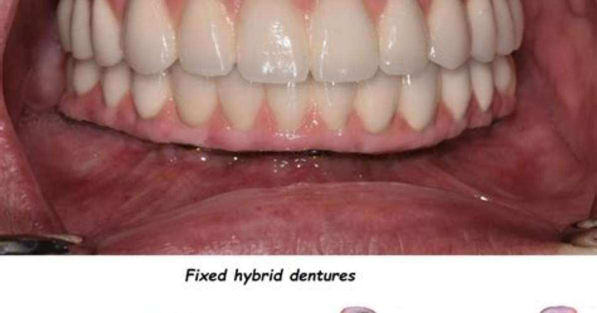 How Dentures Are Fixed?