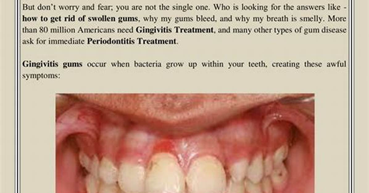 How Do Dentist Treat Gingivitis?