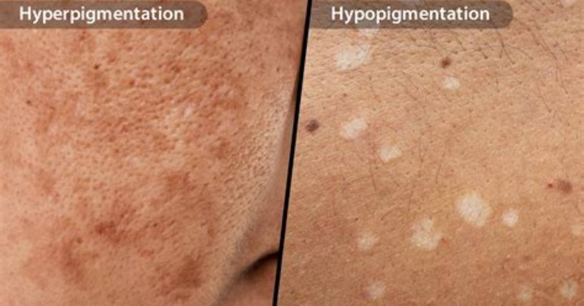 How Do Dermatologists Remove Hyperpigmentation?