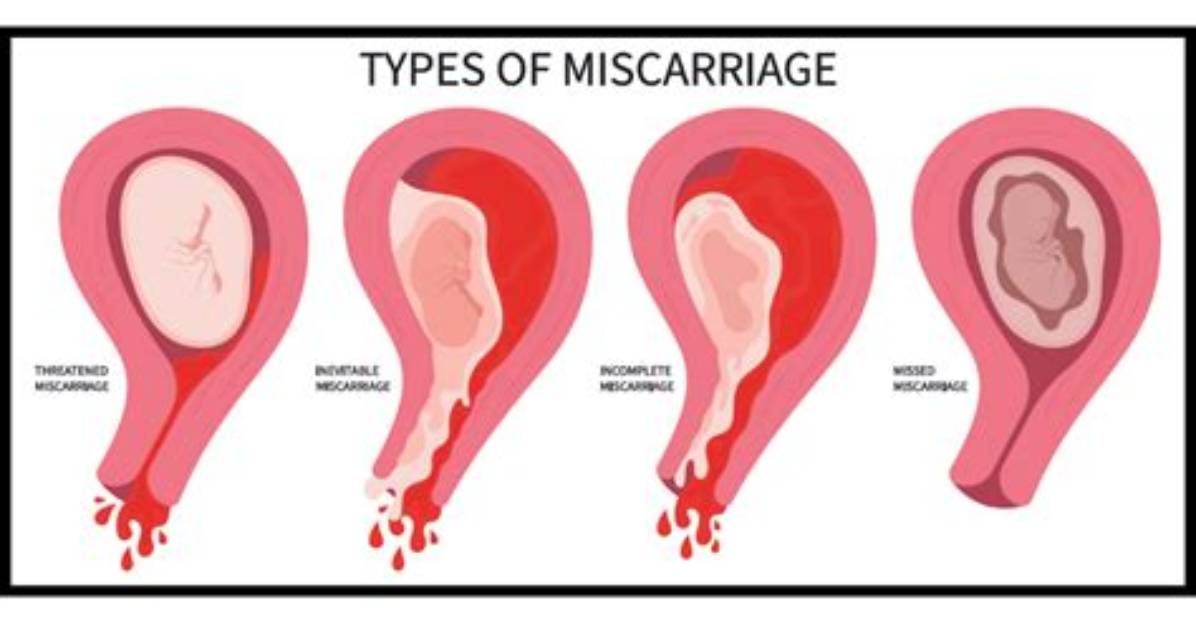 How Do Doctors Test for Miscarriage?