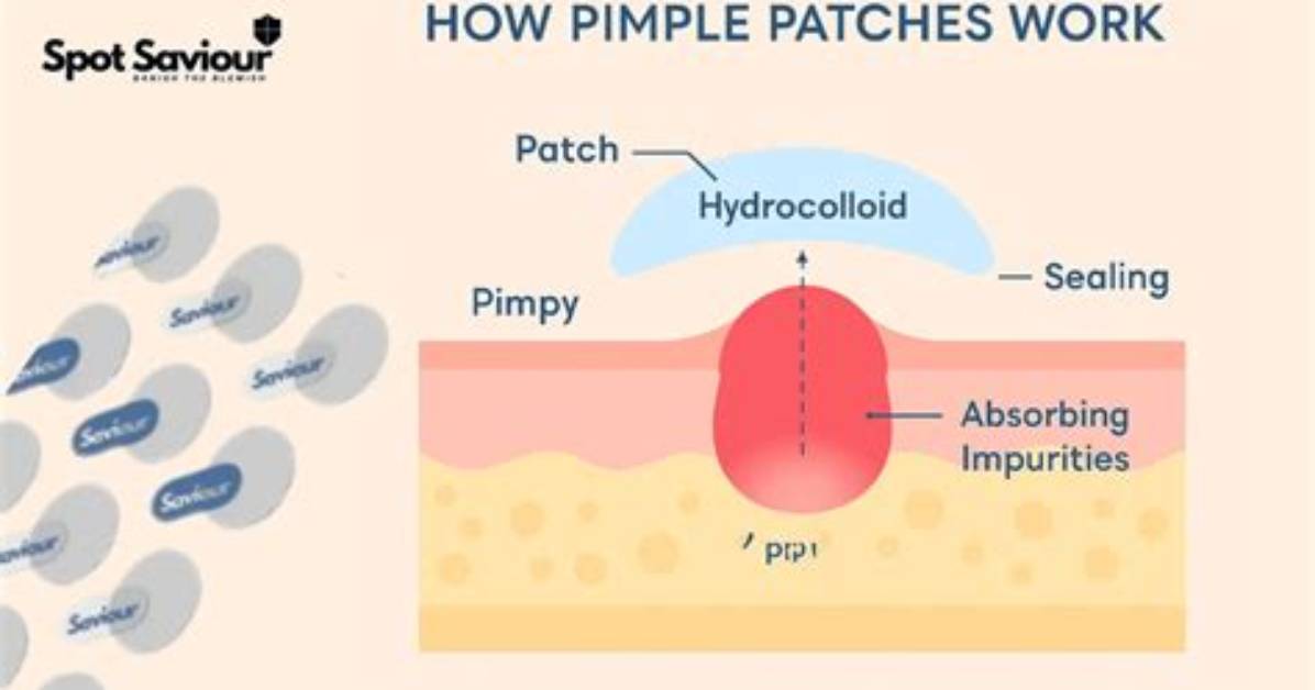 How Do Hydrocolloid Pimple Patches Work
