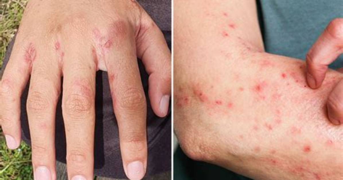 How Do I Know If My Rash Is Fungal?