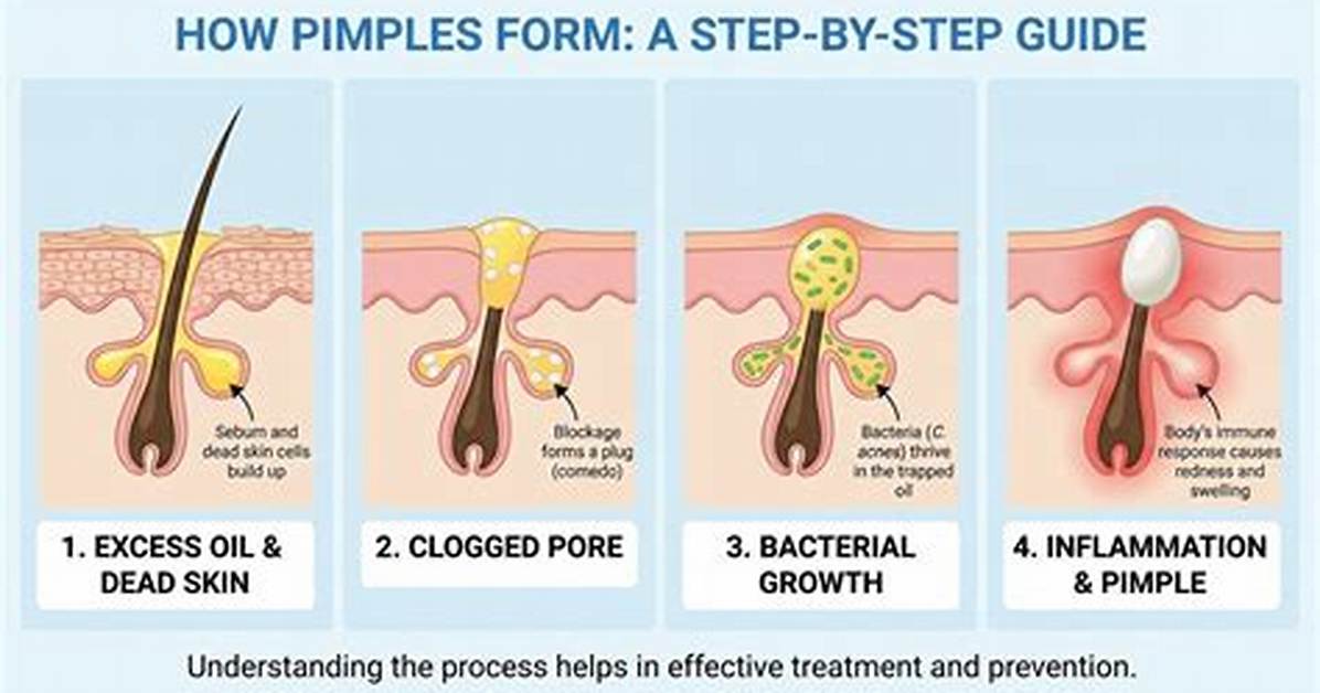 How Do Pimples Form - How to Discuss
