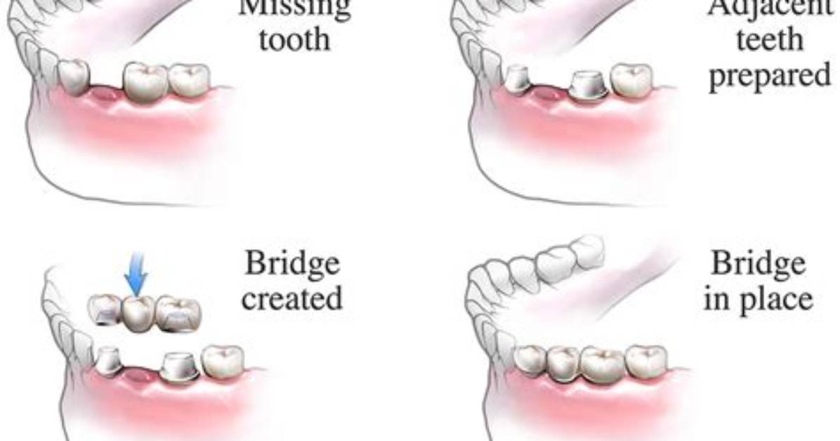 How Do They Remove Bridges from Teeth