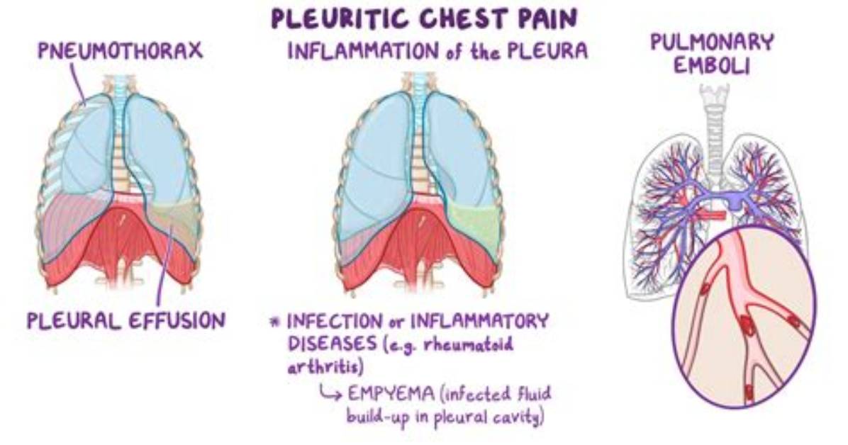 How Do U Say Pleurisy